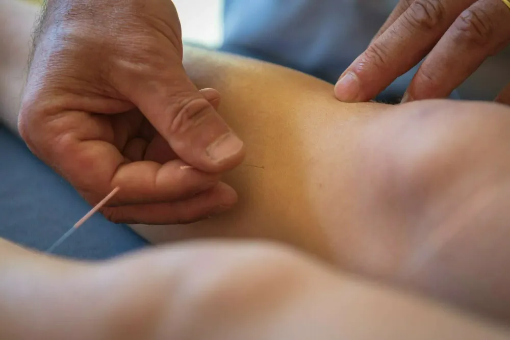 acupuncture (1)